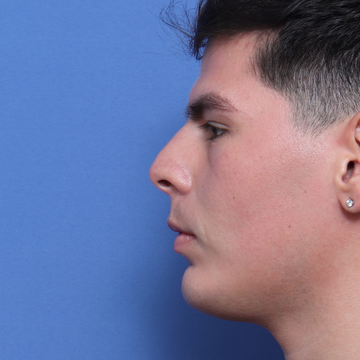 Implante Facial